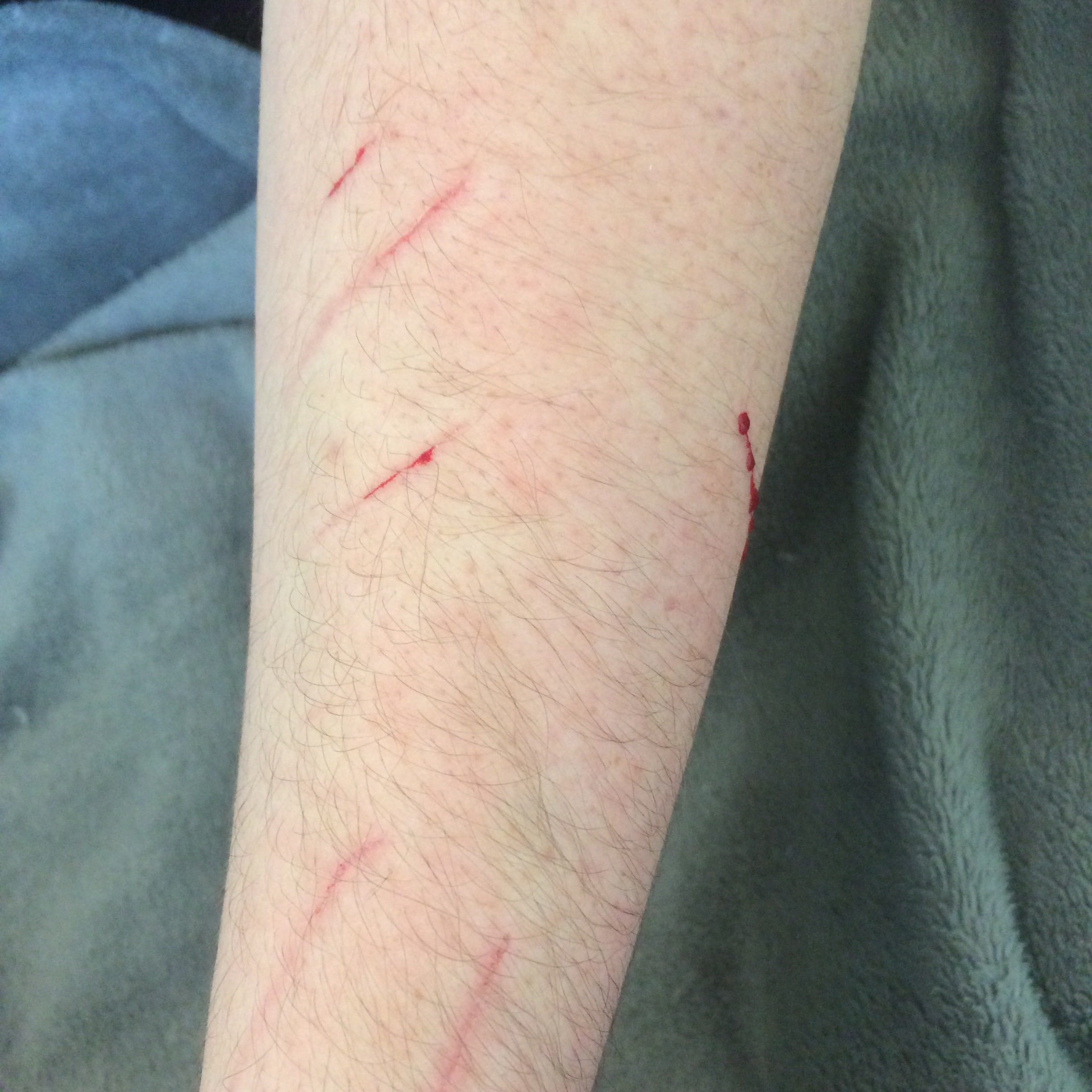 болезнь кошачьих царапин