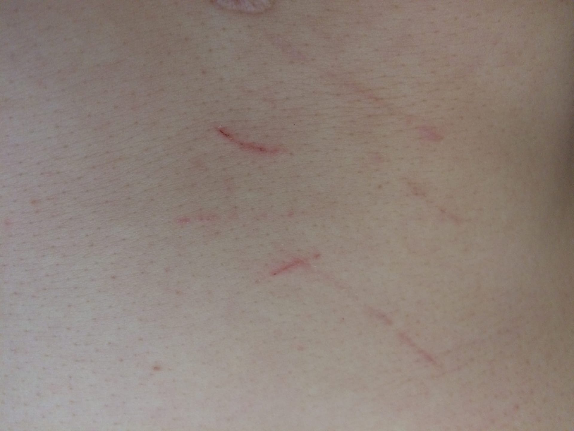 болезнь кошачьих царапин