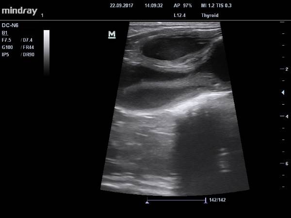 пиометра у кошек - узи